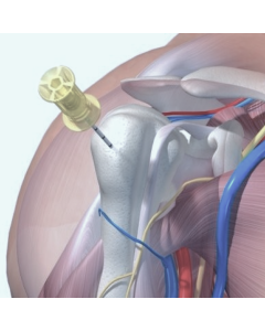 Habilitação em Dispositivo Intraósseo