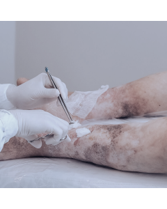 Coberturas, tecnologias e terapias adjuvante no tratamento de feridas